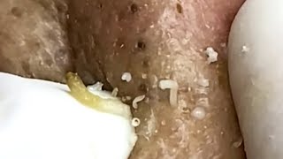 Blackheads & Whiteheads Satisfying Removal Acne and Pimple @0787