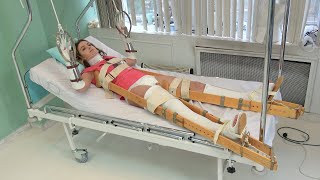 Vintage Splints and Traction on Double Plaster Leg and Arm Casts