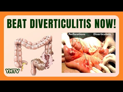 Diverticulitis Diet: Best Foods, Tips & Meal Plans to Heal Diverticulitis