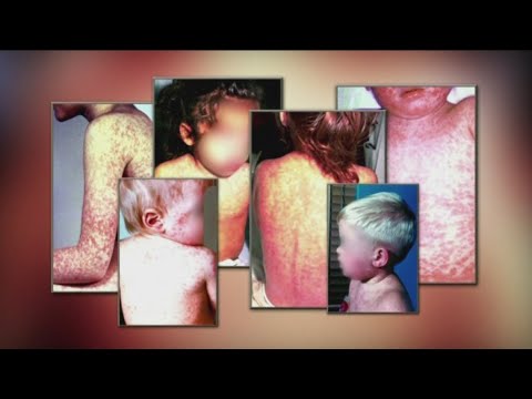 YouTube video thumbnail: Measles Cases Continue to Rise Across the United States, Including in Idaho