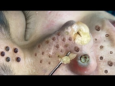 Blackhead Removal With Sac Dep Spa @100074090