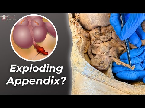 Were We Lied to About Appendicitis? Let's Find Out...
