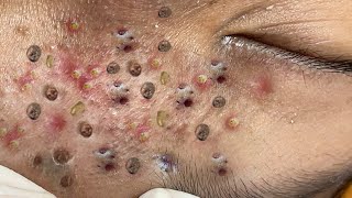 Loan Nguyen Acne Treatment 135c