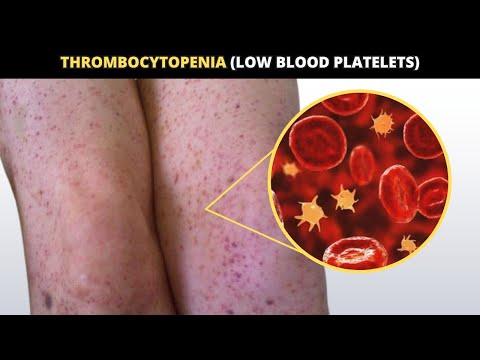 Thrombocytopenia | Causes, Symptoms & Treatment