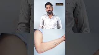 Lipoma Removal Feedback | Lipoma Removal | Lipoma Removal Result