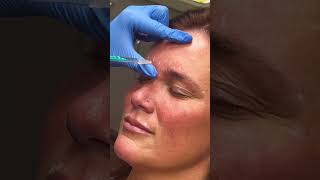 SOFTENED Her Wrinkles, NOT HER EXPRESSIONS with BOTOX! #botox #skincare #beauty #shorts