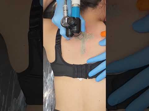 Remoção de Tatuagem sem dor com laser PicoSure
