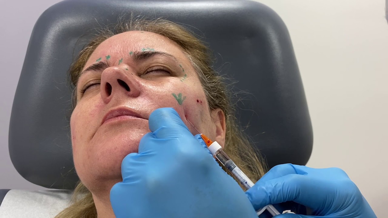 Woman with markings for cosmetic procedure preparation.