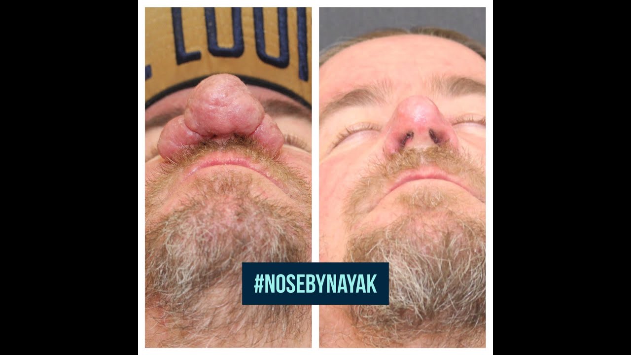 Before and after nose transformation surgery.