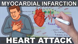 Myocardial Infarction | Heart Attack