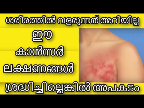 അറിയില്ല ഈ കാന്‍സര്‍ ലക്ഷണങ്ങള്‍ | Health Tips Malayalam | Common and Ignored Symptoms of Cancer