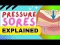 Pressure Sores Prevention and Treatment