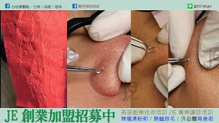 JE無痛清粉刺-全臉地毯式針清60-90分鐘 #林季儀老師 #JE創業加盟招募中