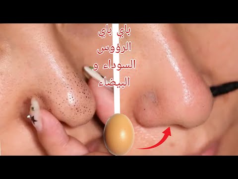 أقسم بالله بيضة واحدة ستخلصك من الرؤوس السوداء والبيضاء والتجاعيد مجربة ومضمونة 100٪ وجهك يرجع مرايا