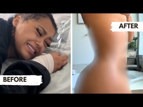 Ally Got INTENSE BBL Surgery! *THE TRUTH ABOUT WHAT HAPPENED*