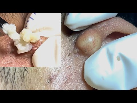 Acne Treatment Huong Da Nang#737 Acne in Ears #shortvideo