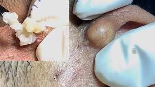 Acne Treatment Huong Da Nang#737 Acne in Ears #shortvideo