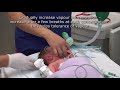 Anesthesia Induction Procedures and Techniques