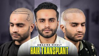 2093 Grafts Hair Transplant in Surat | Amazing Results & Affordable Cost in Surat #hairtransplant
