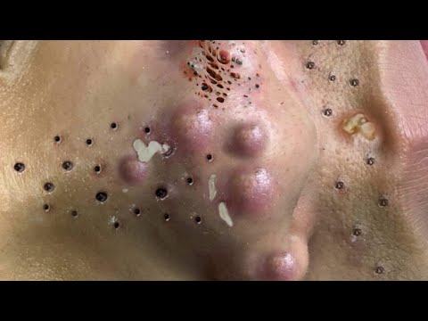 Blackhead Removal With Sac Dep Spa @100074213