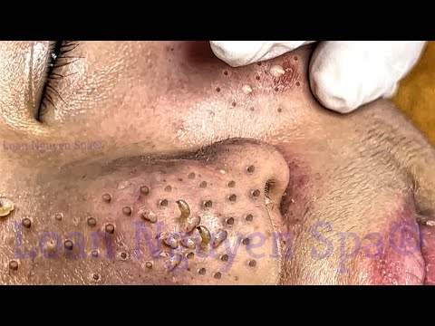 Blackhead Removal With Sac Dep Spa @100074100