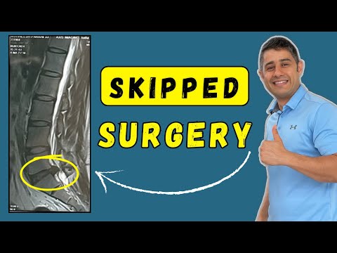 Lumbar Disc Extrusion recovered and skipped surgery