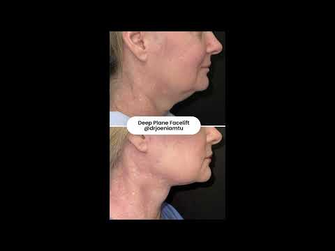 Deep Plane Facelift: Great Little Case #deeplanefacelift #shorts