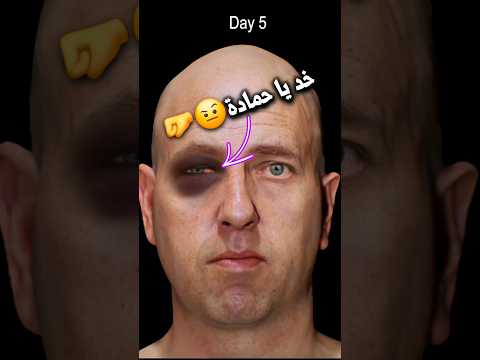 كيف تشفي اصابه العين🧐#shorts