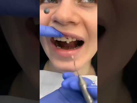 If a gold tooth replaces a broken tooth #viralshort