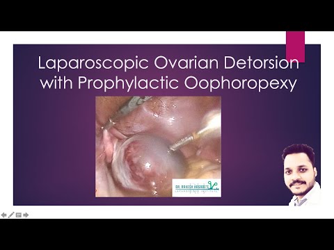 laparoscopic detorsion cpt ovary