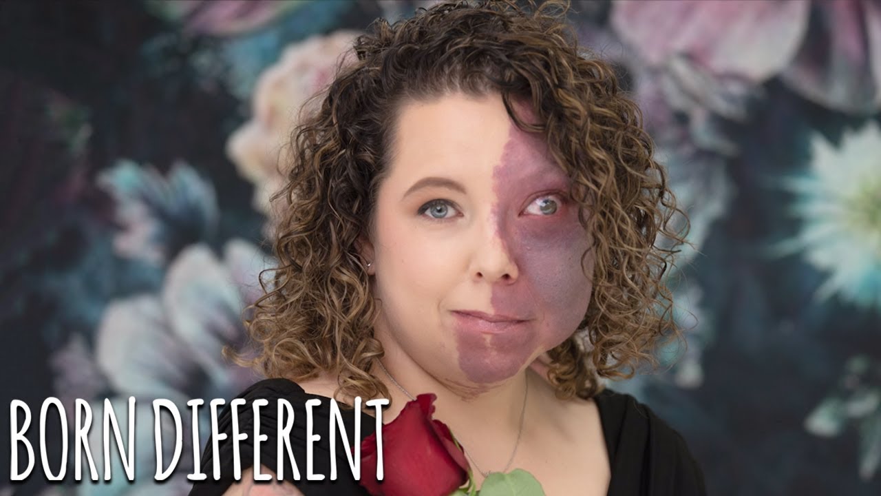I wouldn't leave the house - but i accept my birthmark now - born different