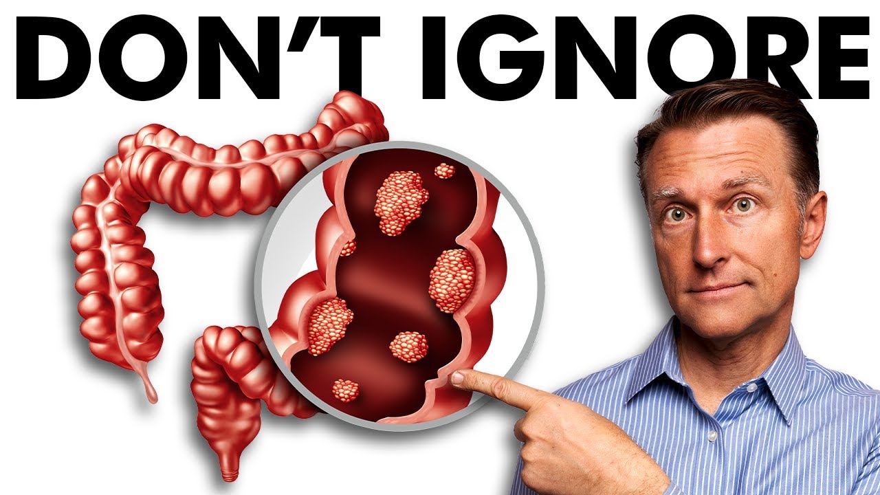 The Early Signs of Colon Cancer You DON’T Want to Ignore