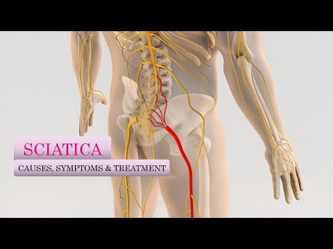 Sciatica: Causes, Symptoms, and Levels of Injury