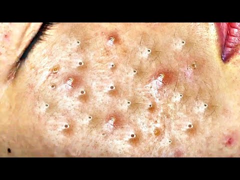 Big Cystic Acne Blackheads Extraction Blackheads & Milia, Whiteheads Removal Pimple Popping # 8708