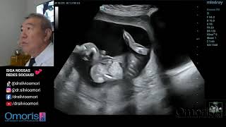 Gestação 17 semanas