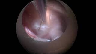 Cystocisternostomy of Sylvian Arachnoid Cyst with the LOTTA® Ventriculoscope