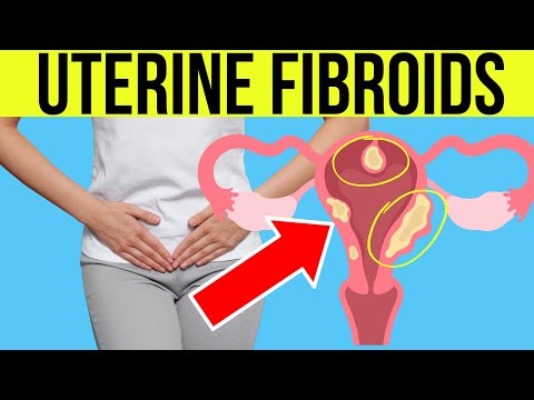 Doctor explains UTERINE FIBROIDS | Symptoms, Causes, Treatment
