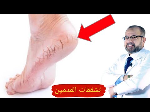 تشقق القدمين وخشونة الجلد والأشف {اعمل الصح} دكتور جودة محمد عواد | دكتور جودة محمد عواد