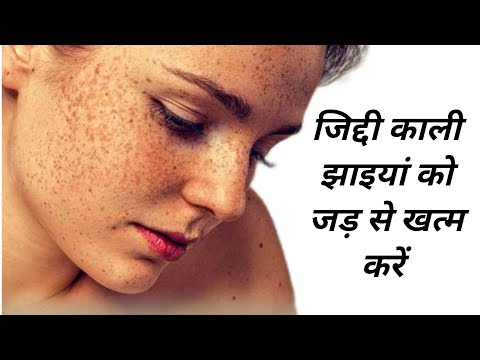 जिद्दी काली झाइयां को जड़ से खत्म करें | Perfect Vanis Cream | Tenovet M Cream | Review in Hindi