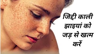 जिद्दी काली झाइयां को जड़ से खत्म करें | Perfect Vanis Cream | Tenovet M Cream | Review in Hindi
