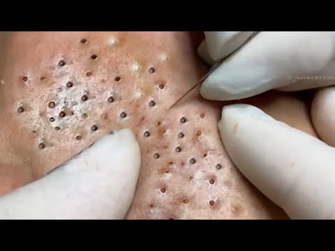 Big Cystic Acne Blackheads Extraction Blackheads & Milia, Whiteheads Removal Pimple Popping # 8705