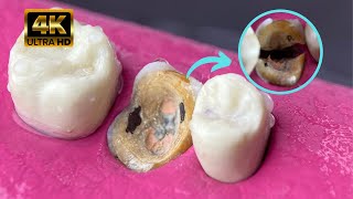 Extracción dental en 4k / Odontosección
