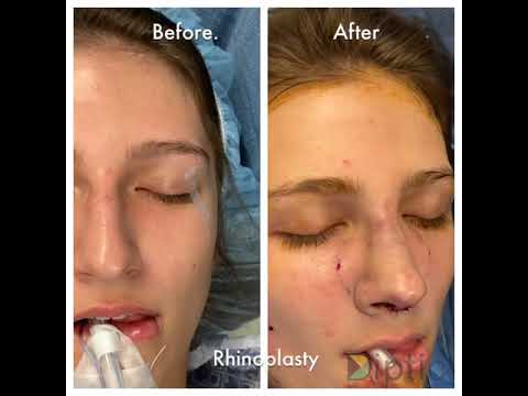 Rhinoplasty before and after comparison photo.