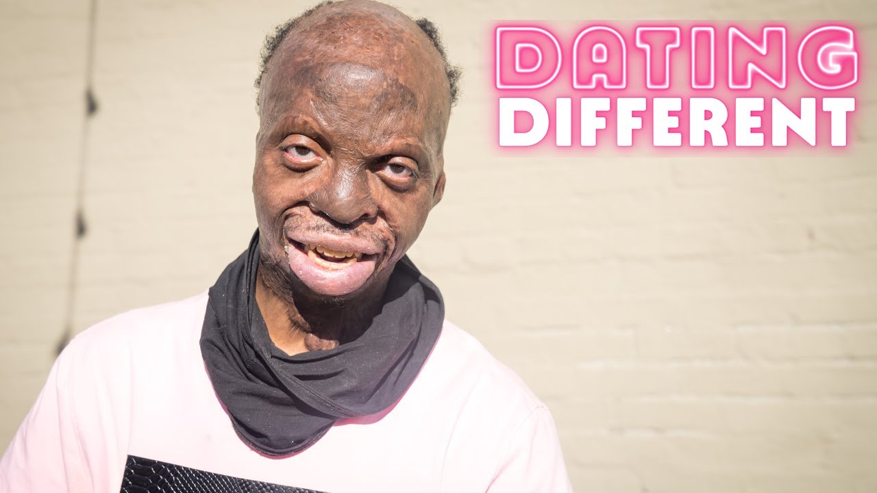 80% of my body is burned, will my blind date care? - dating different