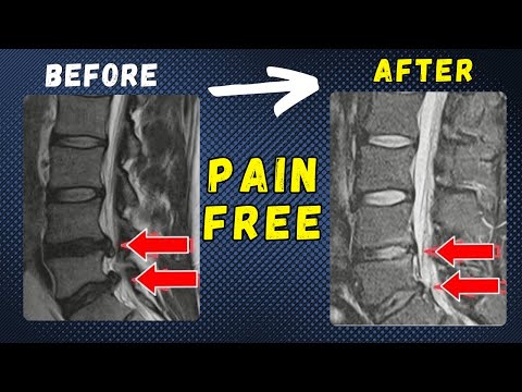 How to fix your back pain without surgery