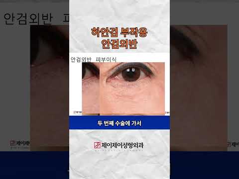 하안검 부작용 안검외반 #하안검 #shorts