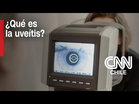 Puede llegar a causar ceguera: ¿En qué consiste la uveítis?