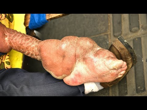 10 Creepy Animals That Can Enter the Human Body