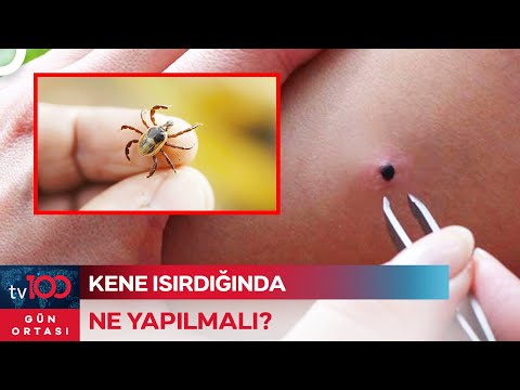 Vücutta Kene Görüldüğünde Ne Yapılmalı? | Gün Ortası