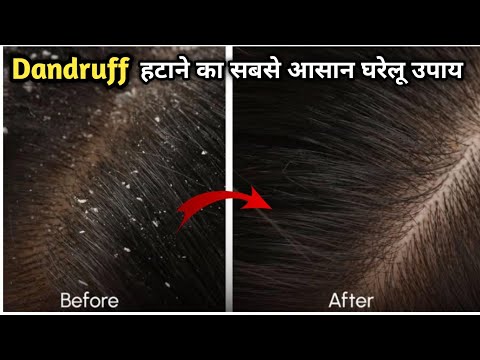 बालों का झड़ना, डैंड्रफ और खुजली को दूर करें in 1st Wash, Remove Dandruff Permanently | 100% Natural